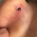 female blacklegged tick on back of ear