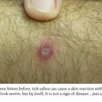 If you have been bitten before, tick saliva can cause a skin reaction within 18-72 hours. It can look severe, but by itself, it is not a sign of disease....just a bite.