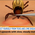 Protect yourself from ticks and lyme disease. Pull upwards with slow, steady motion