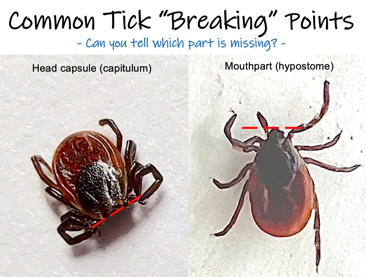 tick-removal-lyme-disease-action