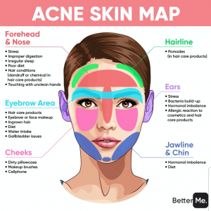 Acne Skin Map