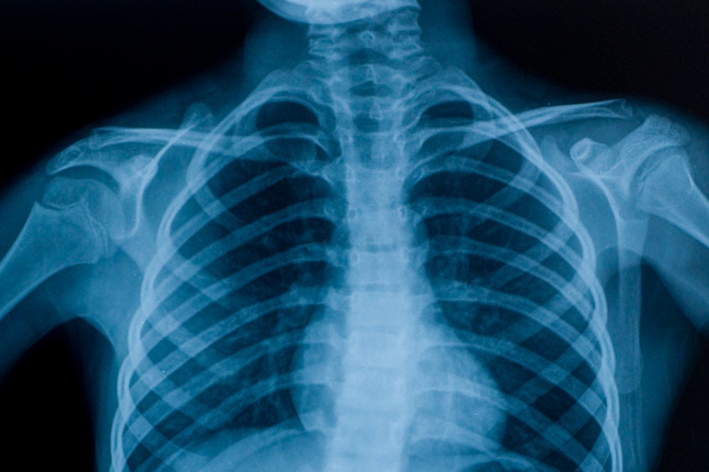 X-ray of human torso