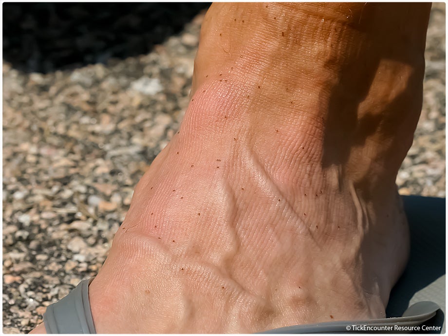 Mans foot in flip flops with many larval ticks on it