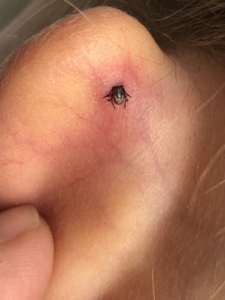 female blacklegged tick on back of ear