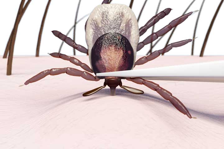 animation of a tick being grasped at the head by pointy tweezers
