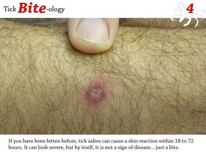 If you have been bitten before, tick saliva can cause a skin reaction within 18-72 hours. It can look severe, but by itself it is not a sign of disease....just a bite.